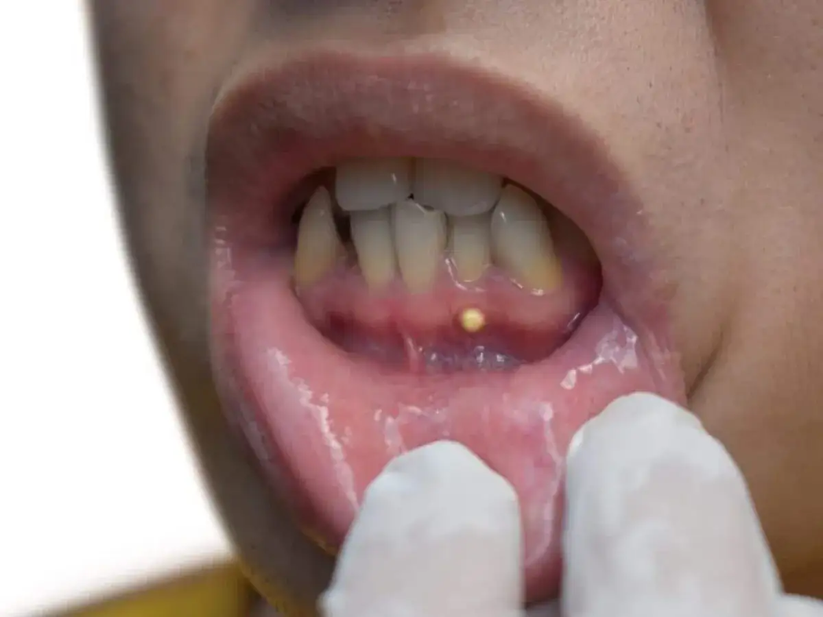 Bolsa periodontal con pus visible en la enc&iacute;a, cerca de los dientes.