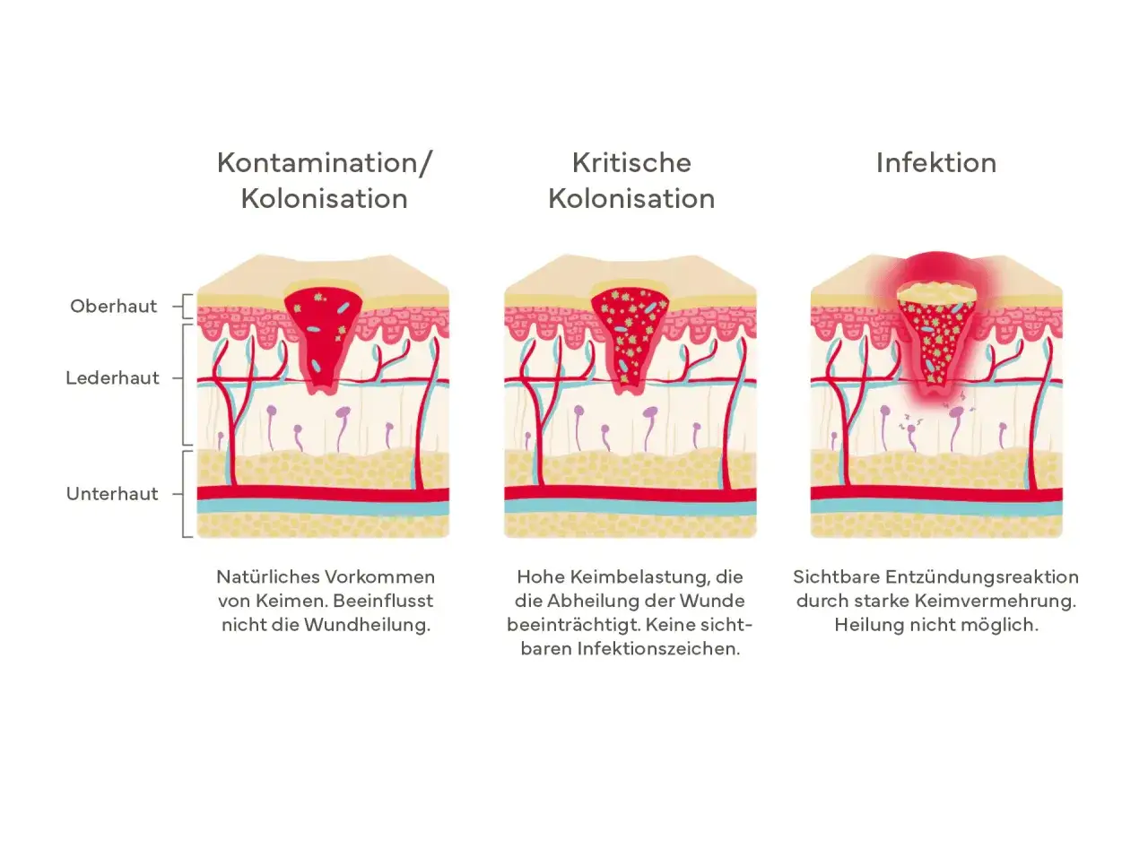 Illustrationen zeigen Hautschichten mit Wunden: Kontamination, kritische Kolonisation und Infektion. Wichtige Infos f&uuml;r die wundversorgung nach op zu hause.