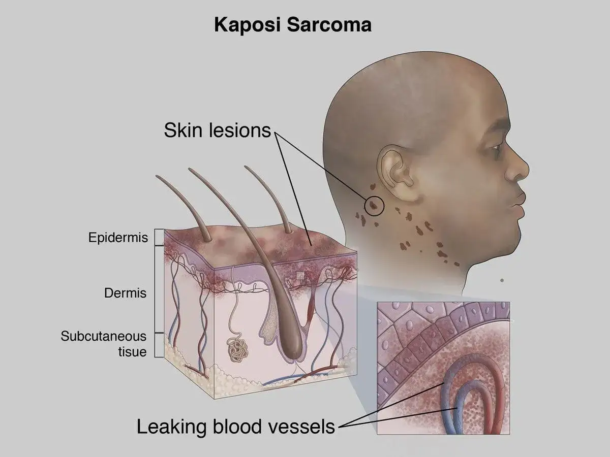 Illustrazione del sarcoma di Kaposi con lesioni cutanee su un volto e sezione trasversale della pelle che mostra vasi sanguigni che perdono.