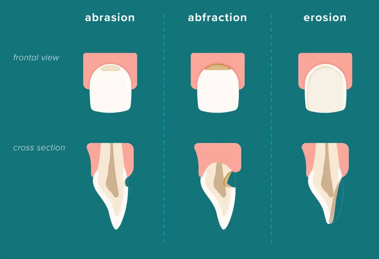 Ilustraci&oacute;n de **abrasi&oacute;n dental** y otras afecciones. Muestra vistas frontales y cortes transversales de dientes afectados.