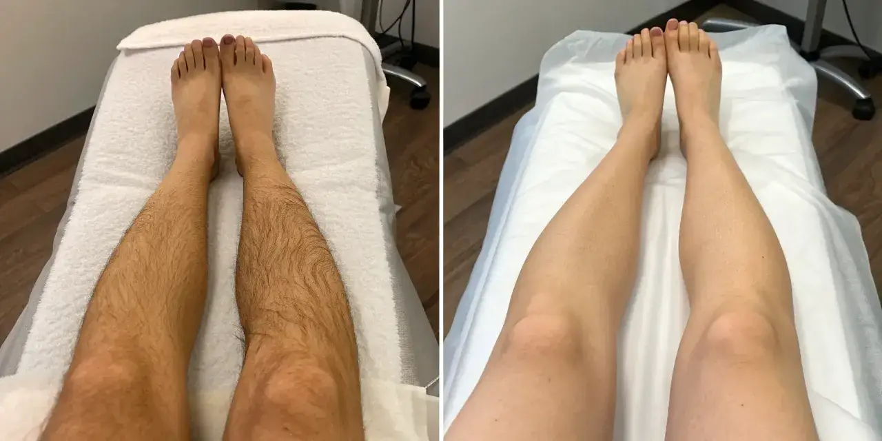Przed i po depilacji laserowej. Zobacz, jak wiele zabiegów potrzeba, by uzyskać gładkie nogi.