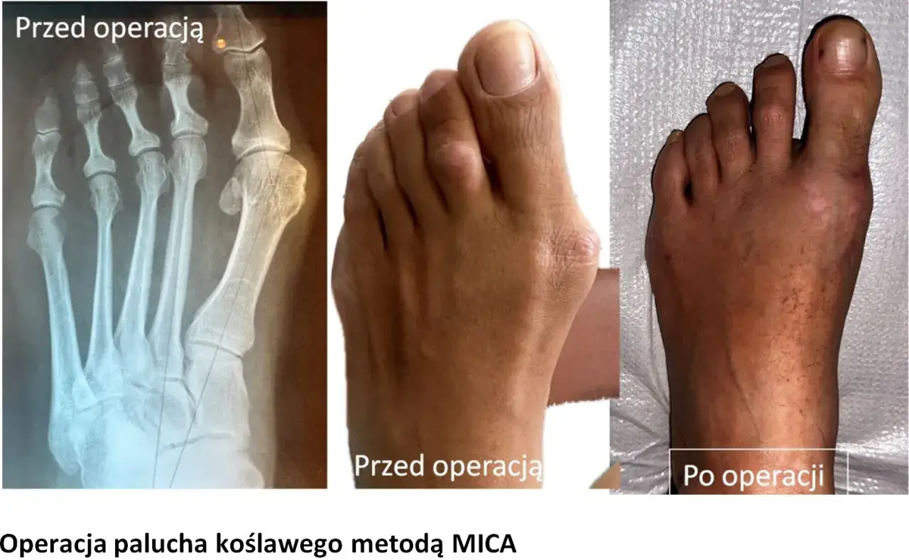 Zdjęcie rentgenowskie i zdjęcia stopy przed i po operacji haluksa. Widać znaczną poprawę po zabiegu.