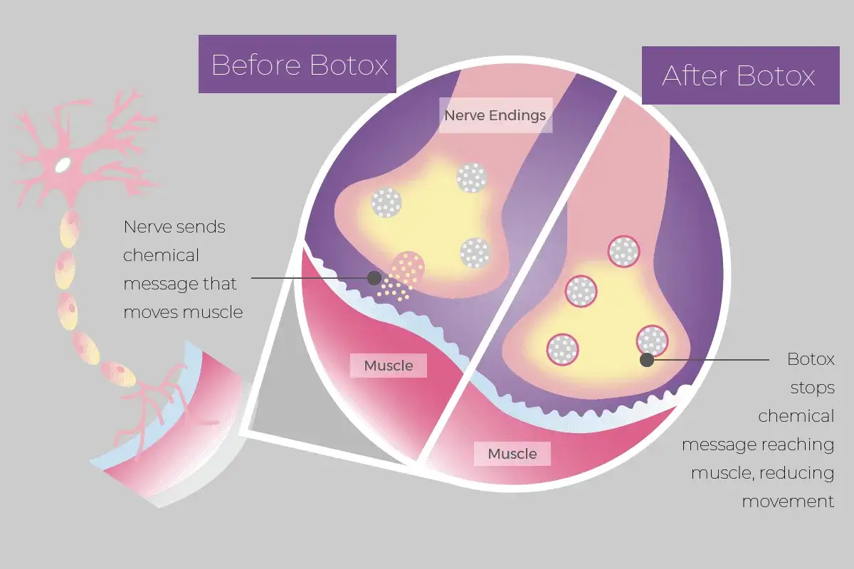 Illustratie toont hoe botox de zenuwsignalen blokkeert. Dit kan impliceren dat botox slecht voor hersenen is, door de communicatie te verstoren.