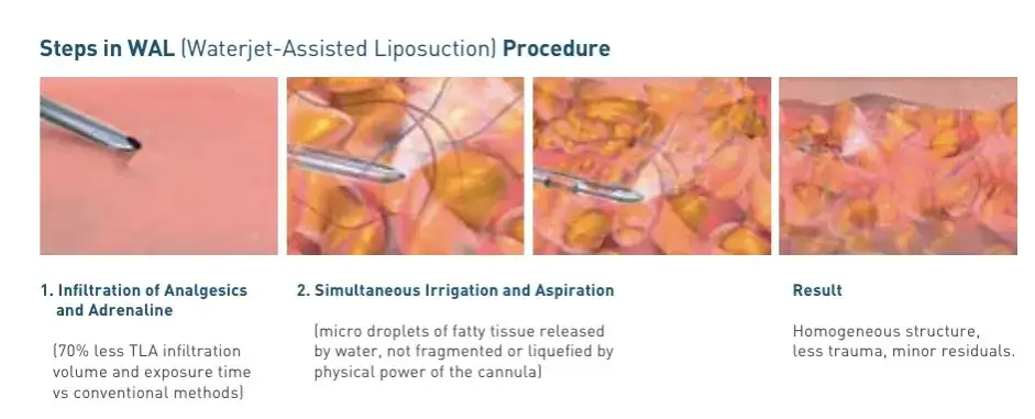 liposukcja schemat zabiegu