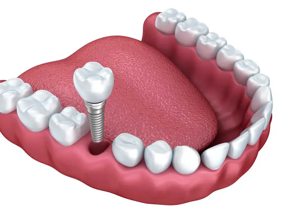 Zdjęcie Odrzucenie implantu zęba po jakim czasie? Poznaj kluczowe czynniki