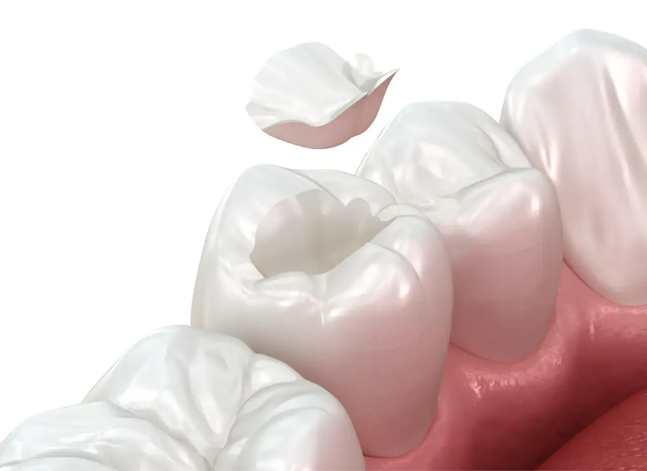 Preparazione intarsio dentale: un dente con una cavità pronta per ricevere un restauro su misura, mentre un frammento bianco fluttua sopra.