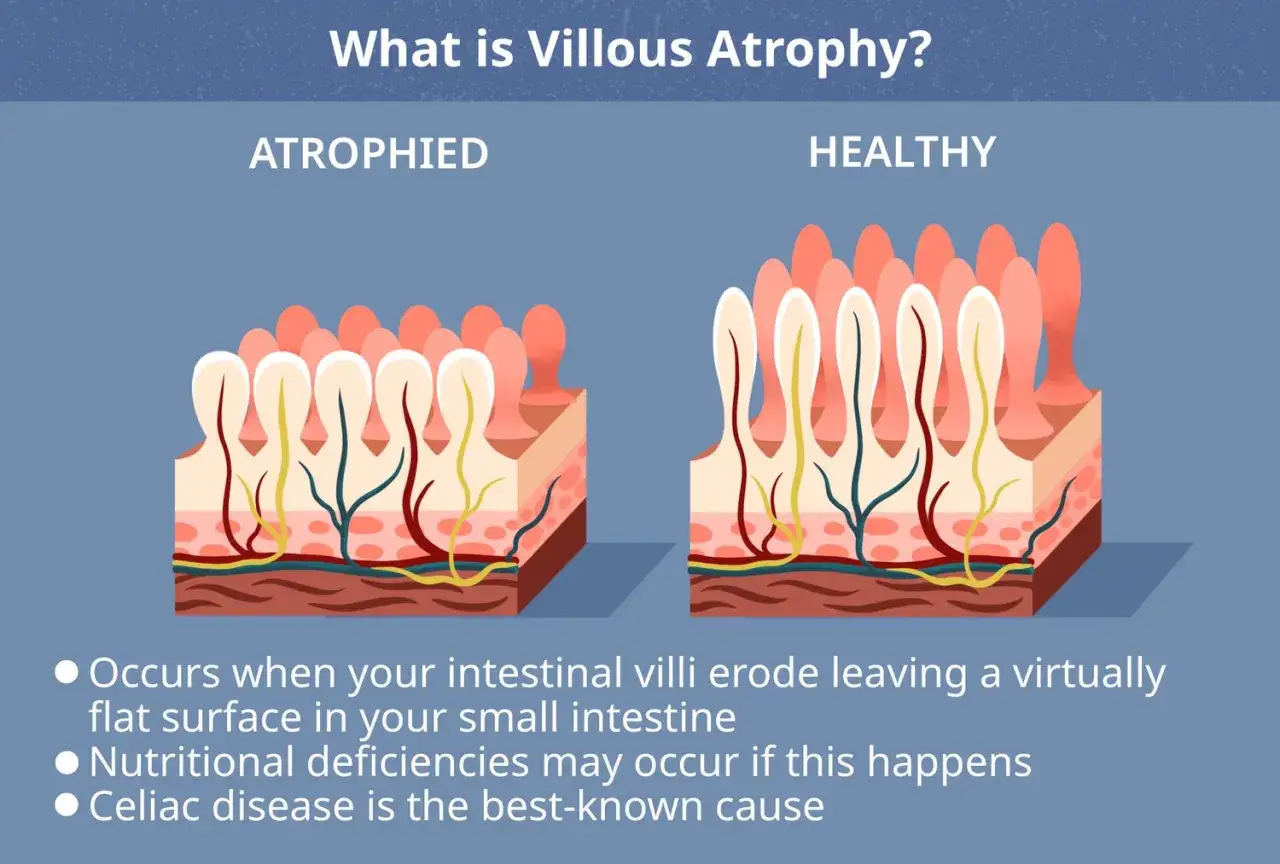 Confronto tra villi intestinali sani e atrofizzati, con la celiachia come causa principale dell'atrofia villosa.