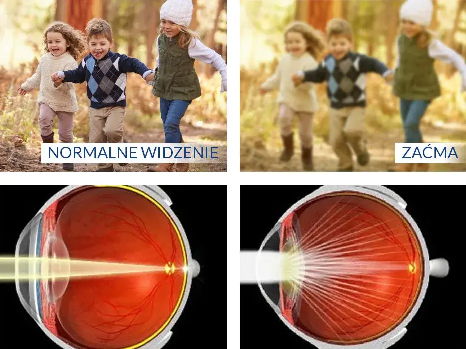 Obraz symulujący widzenie z zaćmą (przymglone, zamglone)