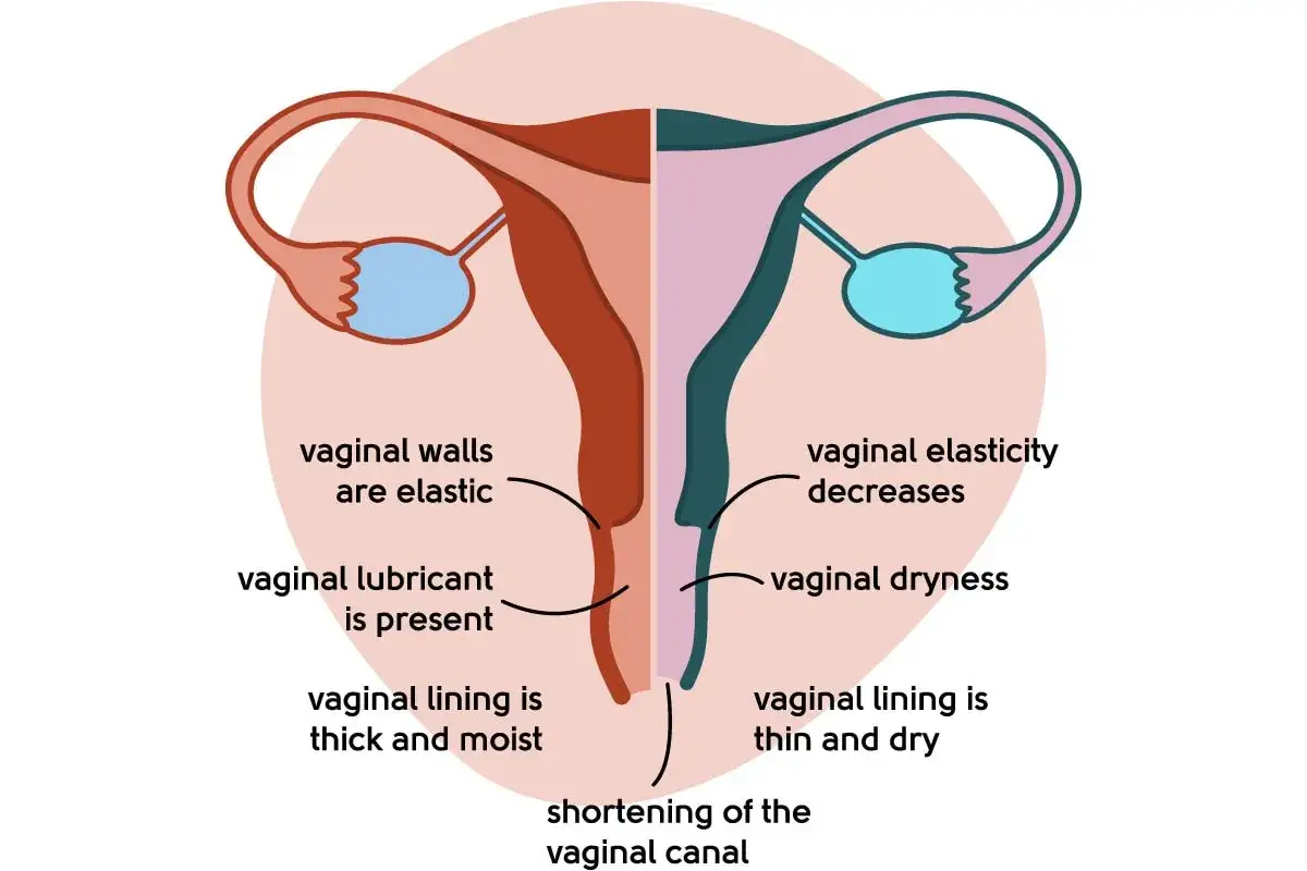 Illustration visar hur klimakteriet p&aring;verkar underlivet: minskad elasticitet, torrhet och att urin luktar illa.