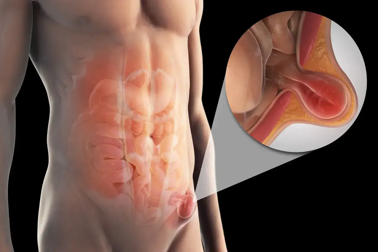 Anatomia przepukliny pachwinowej, gdzie jelita uwypuklają się przez osłabione wiezadlo pachwinowe.
