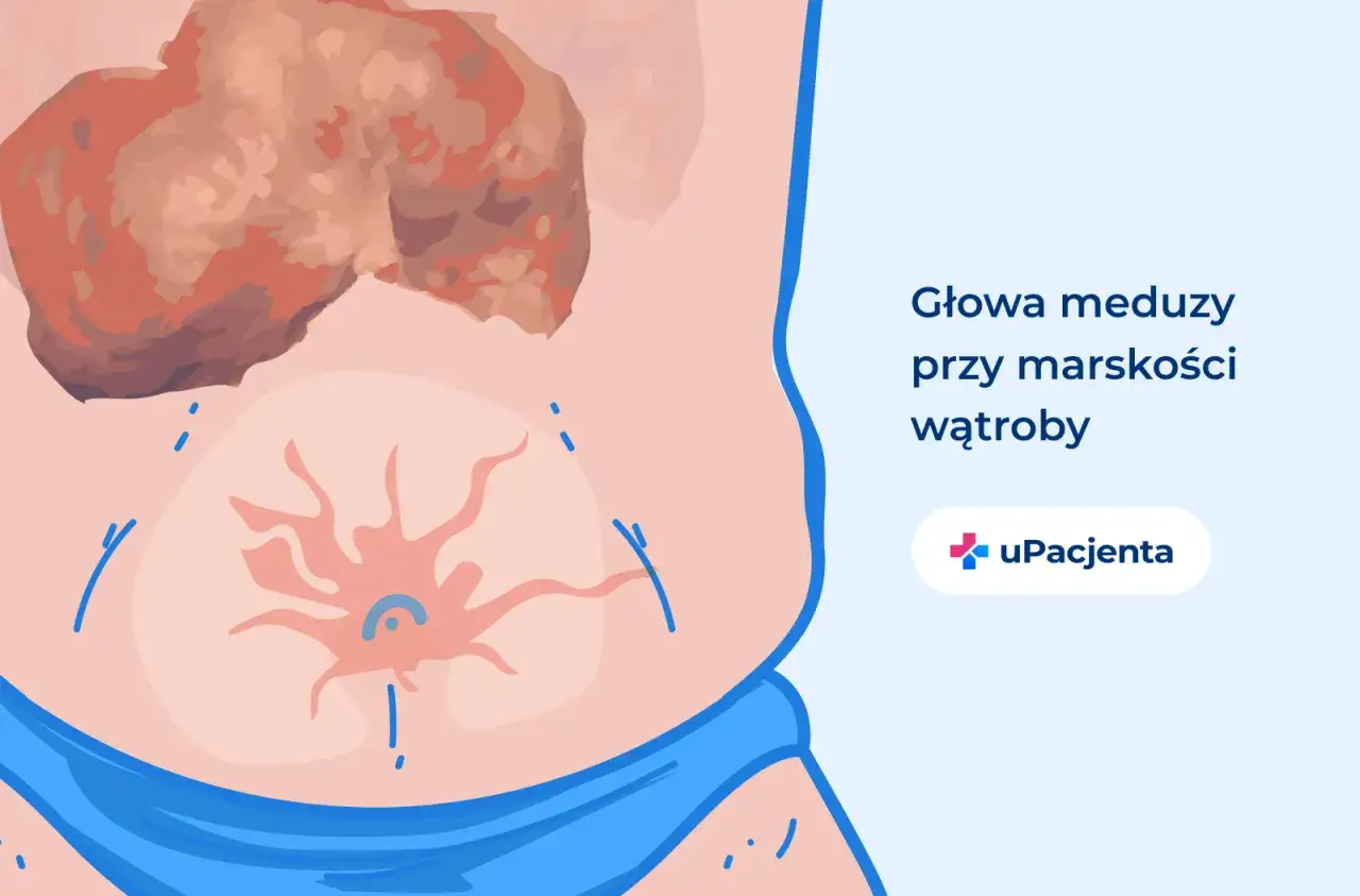Głowa meduzy na brzuchu, objaw marskości wątroby.