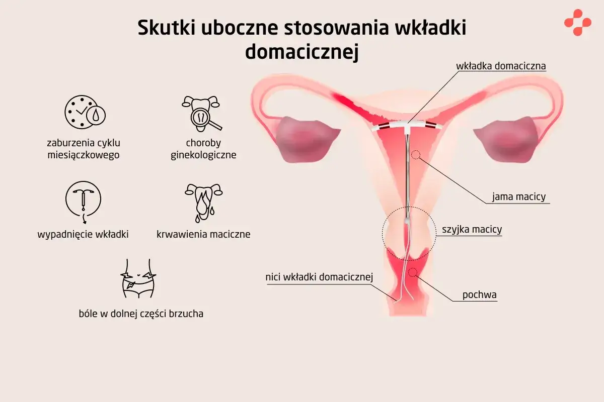 Ilustracja przedstawia skutki uboczne wkładki domacicznej, w tym zaburzenia cyklu miesiączkowego i krwawienia maciczne.