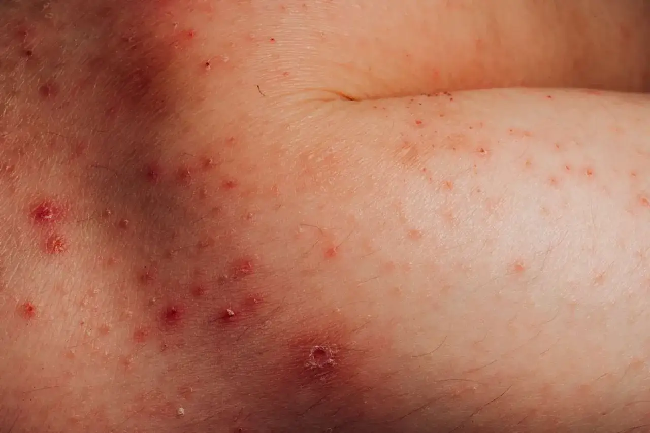 Haut mit roten Pusteln und Schuppen, ein Zeichen für juckende Haut während der Wechseljahre.