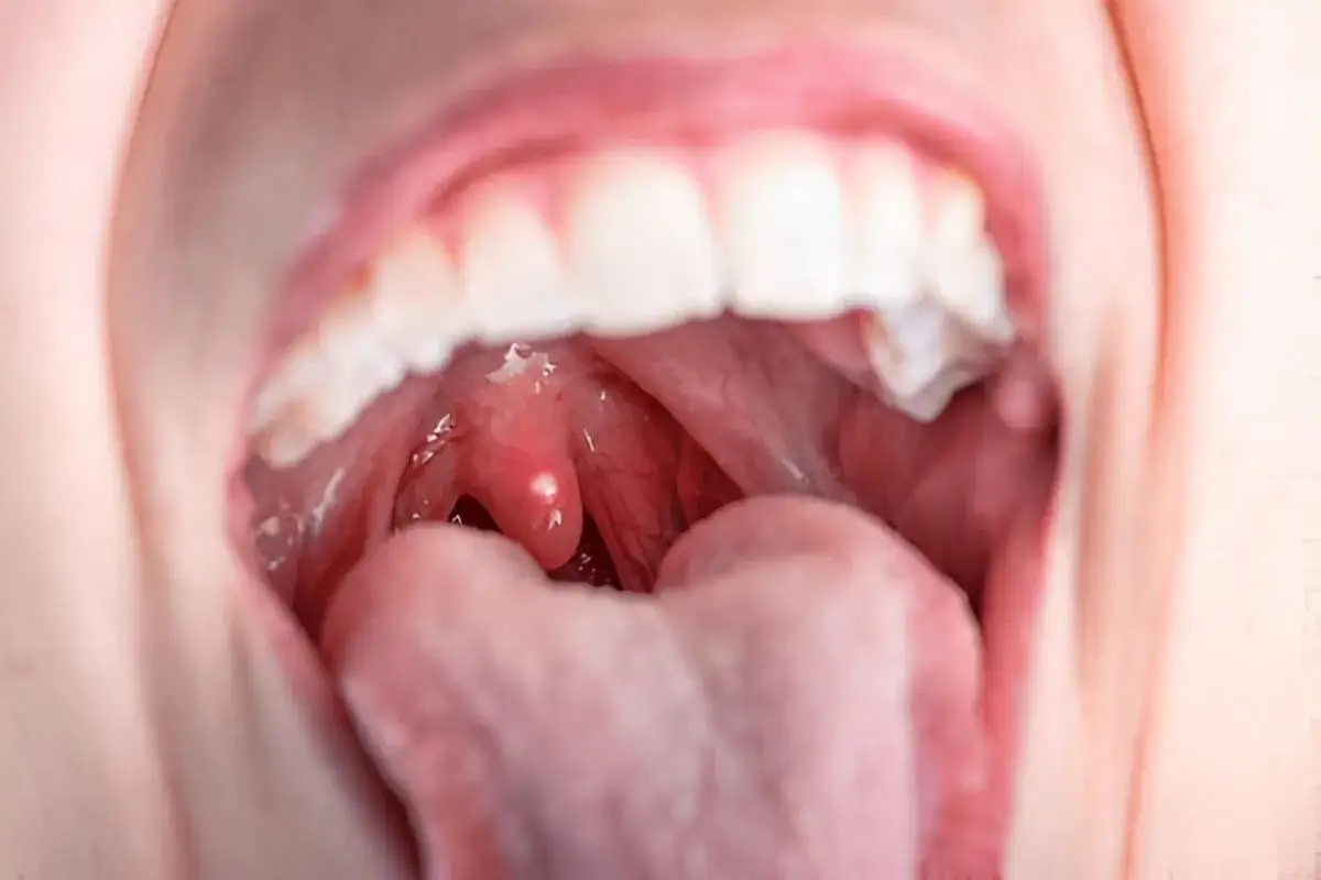 Gola arrossata e tonsille gonfie, con una piccola protuberanza su una di esse, sintomo di infiammazione.