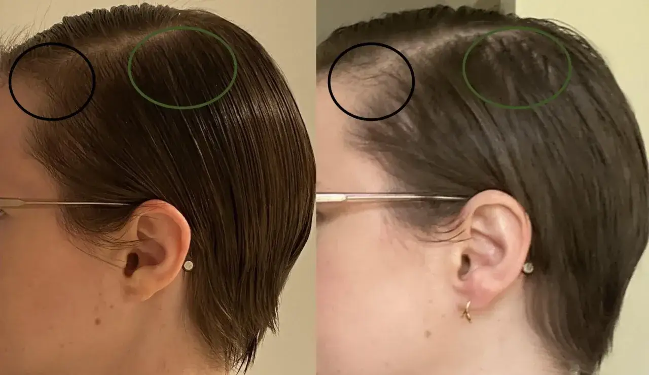 Comparaison avant/apr&egrave;s : cheveux clairsem&eacute;s sur les tempes, possiblement li&eacute;s &agrave; une carence en fer. La repousse semble plus dense.