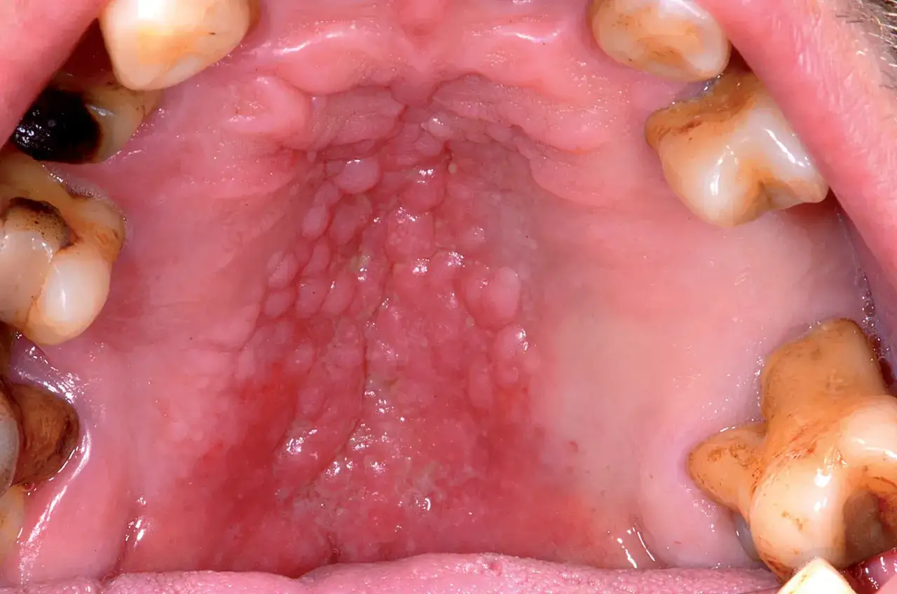 Palato con aree arrossate e gonfie, con piccole protuberanze. Si nota una macchia scura sul palato, vicino ai denti.