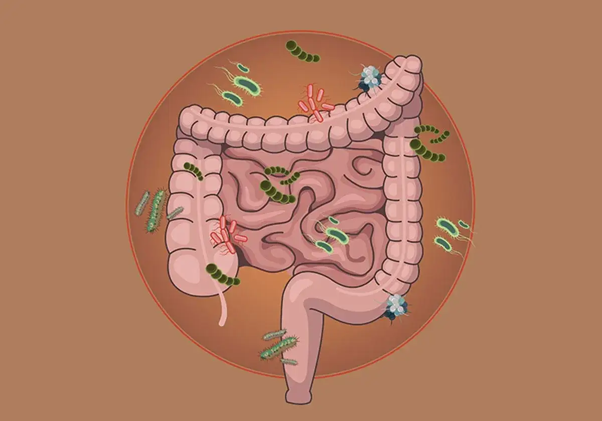 Illustrazione di un intestino con batteri e funghi, suggerendo la ricerca di una candida intestinale cura definitiva.