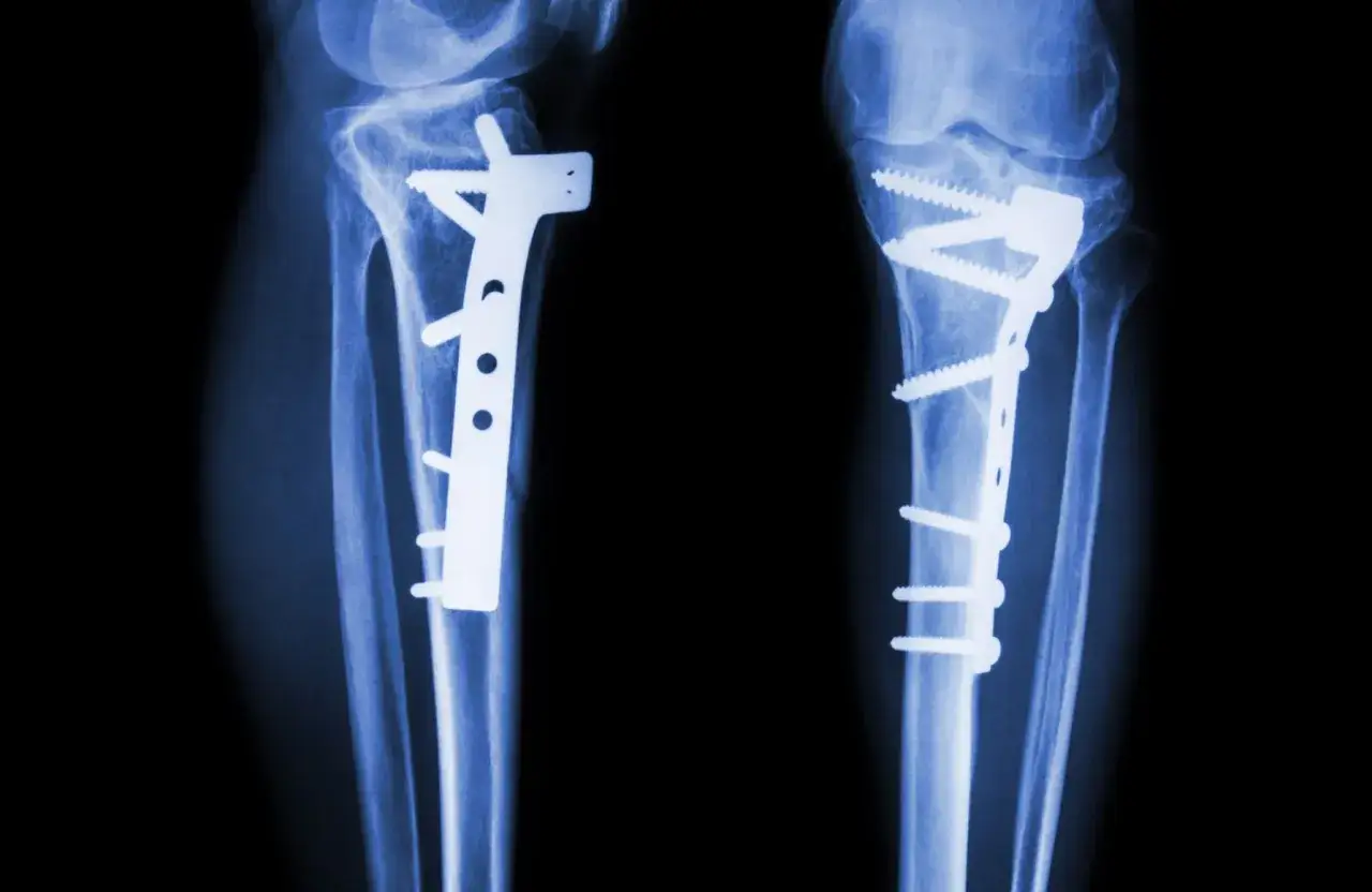 RTG kolan z implantami po osteotomii. Dwie nogi z płytkami i śrubami stabilizującymi kości.