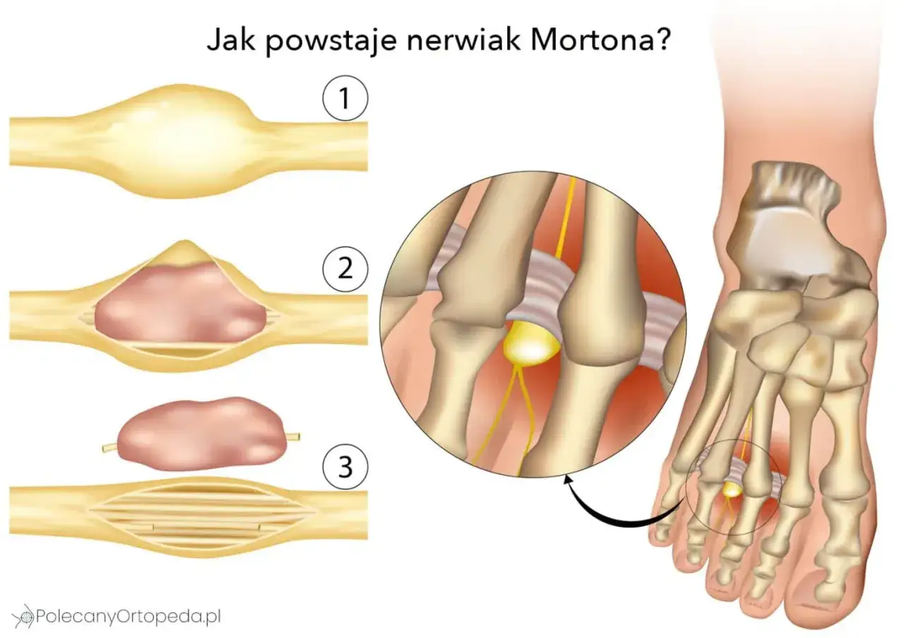 Ilustracja pokazuje powstawanie nerwiaka Mortona: zgrubienie nerwu w stopie, które uciska inne nerwy.