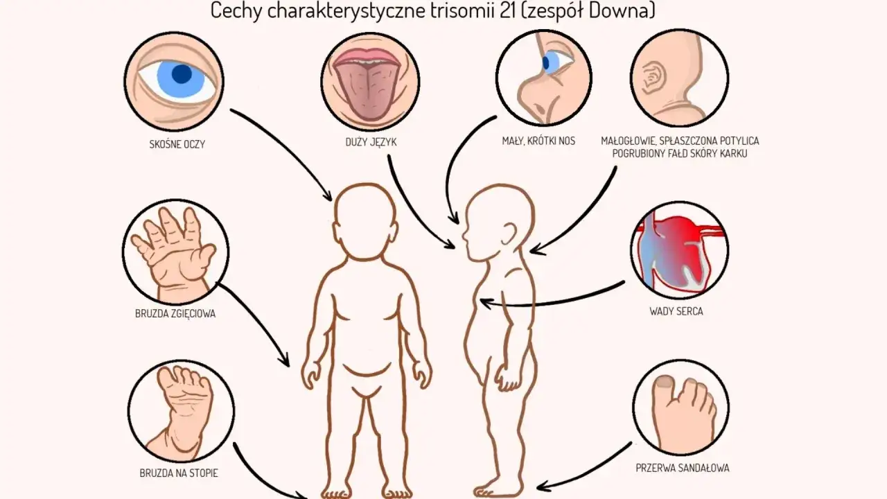 Ilustracja przedstawia cechy charakterystyczne zespołu Downa: skośne oczy, duży język, mały nos, płaską potylicę, bruzdy na dłoniach i stopach, wady serca.