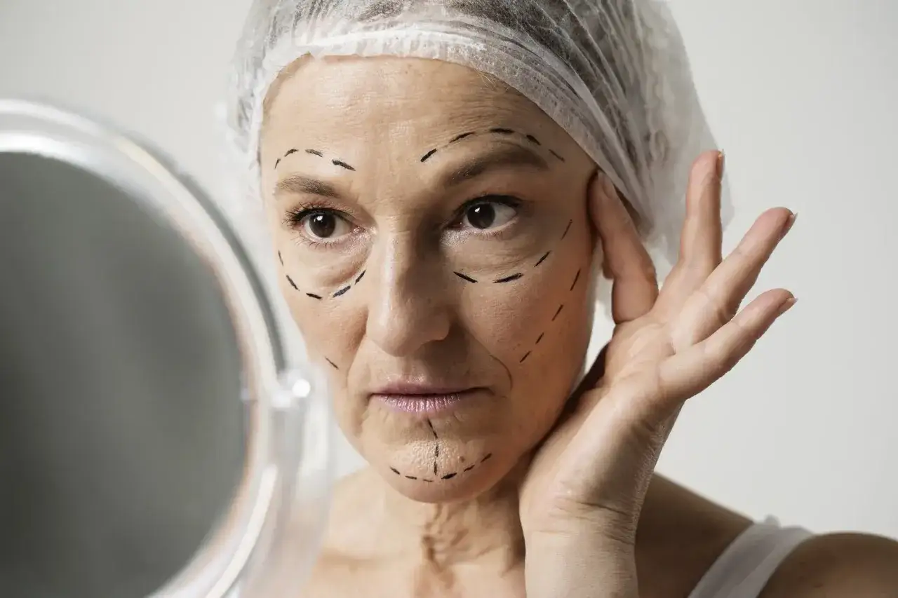 Mujer con marcas en el rostro, preparándose para un procedimiento estético para atenuar las arrugas de expresión.