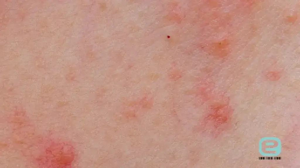 rumień alergiczny wysypka pokarmowa zdjęcia
