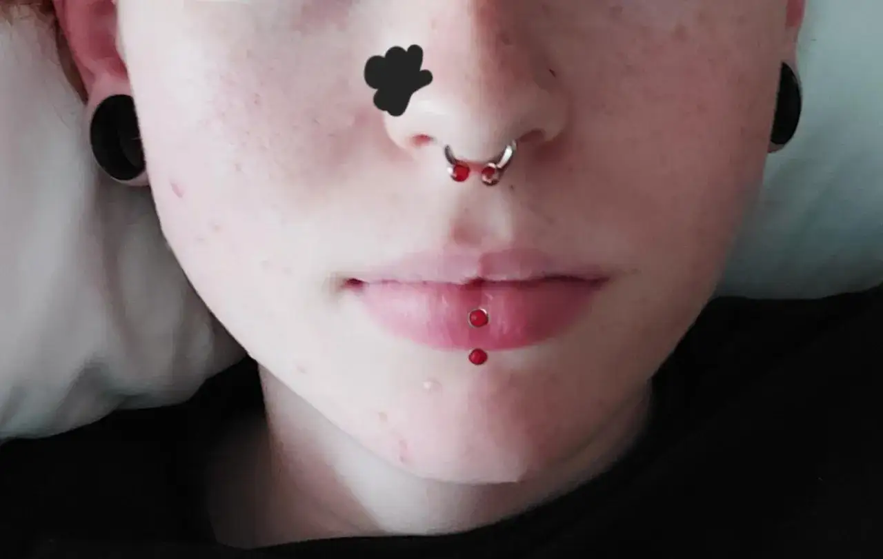 Zbliżenie na twarz z septum i pionowym labretem. Widać gojenie pionowego labretu, z dwoma czerwonymi koralikami.