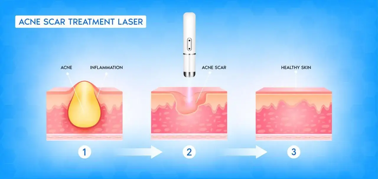 Illustration zeigt die Behandlung von Akne-Knoten und Narben mit einem Laser, der zu gesunder Haut führt.