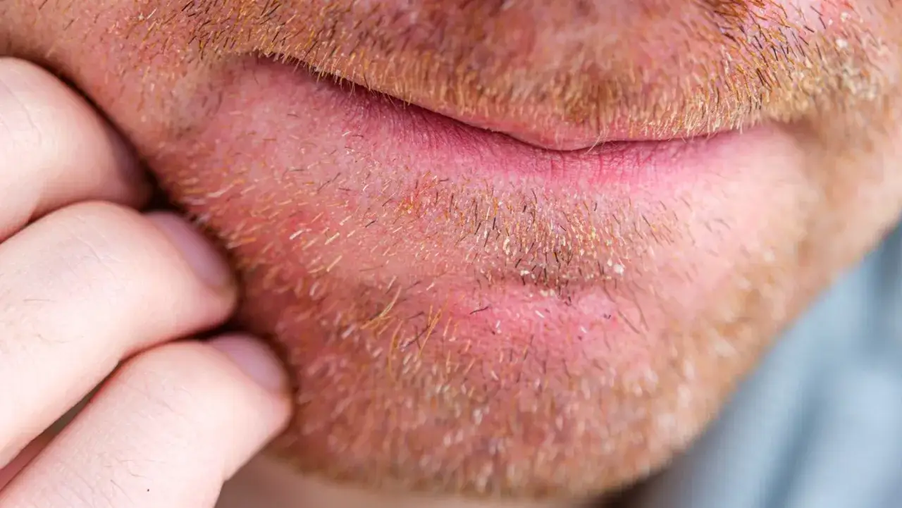 Piel enrojecida y escamosa bajo la barba, indicativo de dermatitis seborreica en la barba. Un dedo rasca la zona.