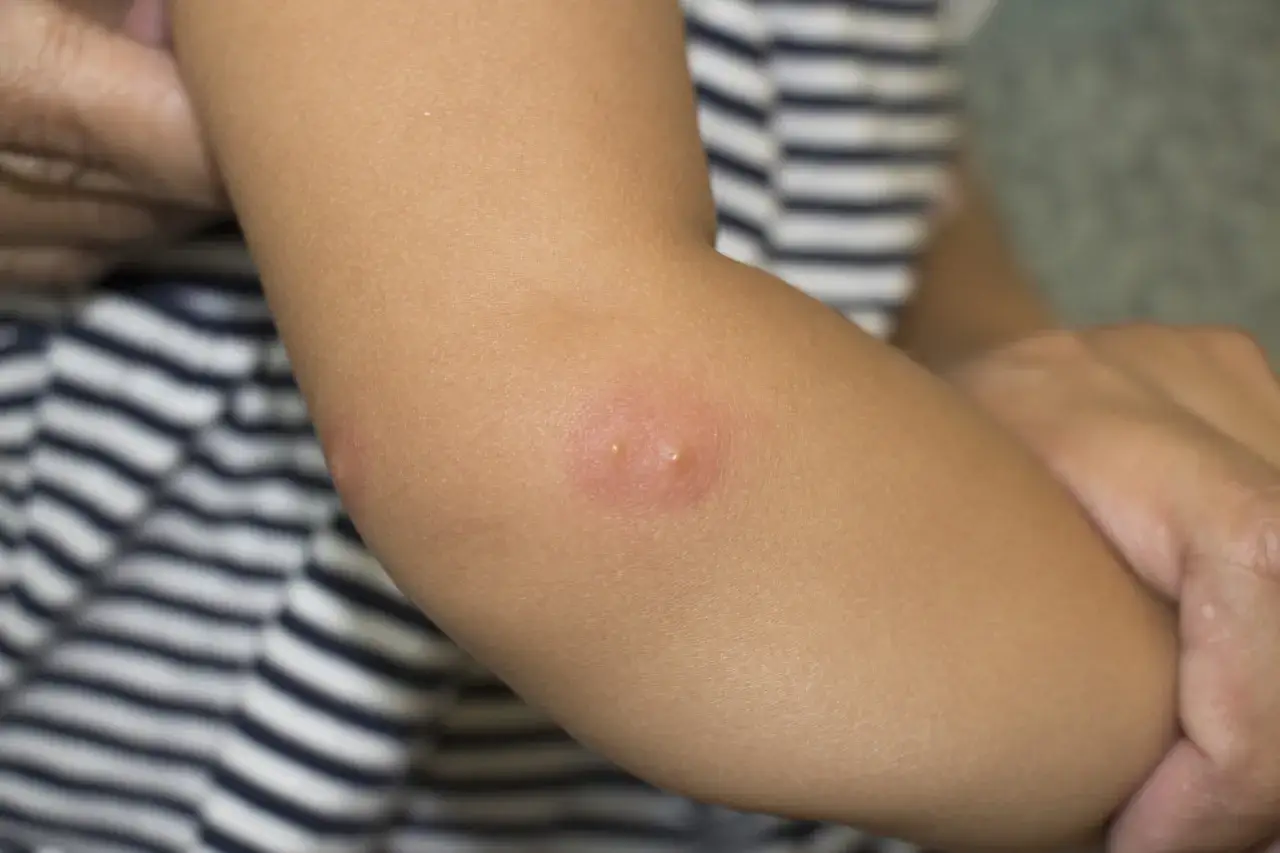 Brazo de ni&ntilde;o con picaduras rojas e inflamadas, buscando remedios caseros para picaduras de mosquitos.