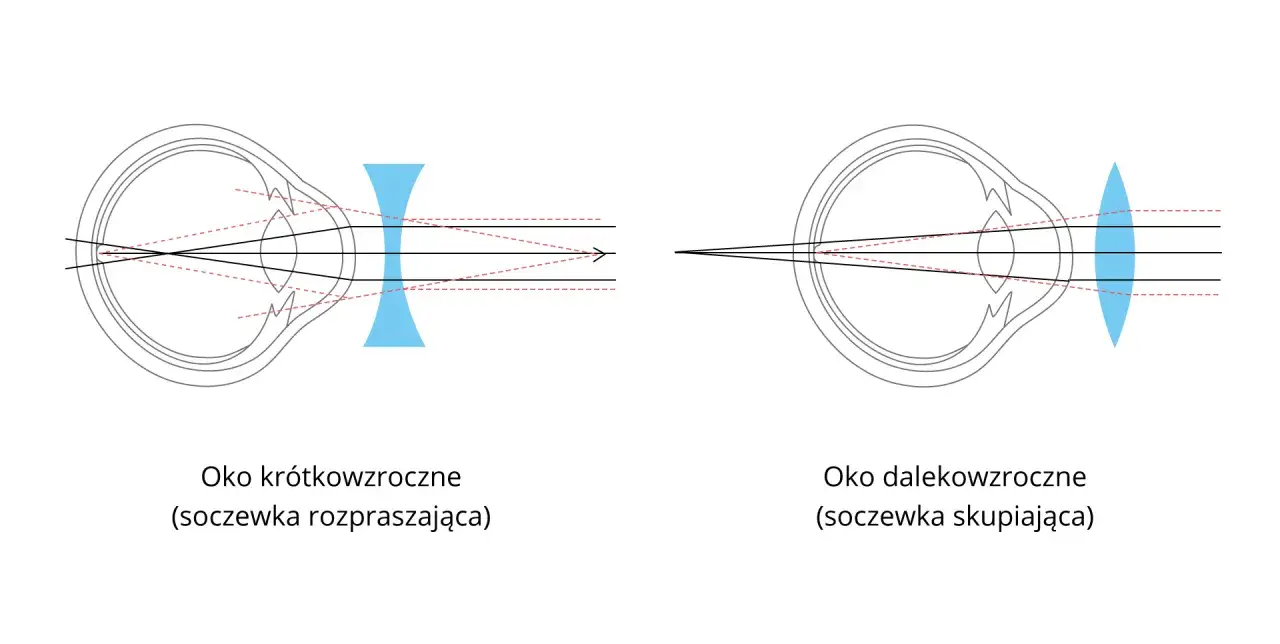 Schemat oka krótkowzrocznego z soczewką rozpraszającą i dalekowzrocznego z soczewką skupiającą, ilustrujący załamanie światła.