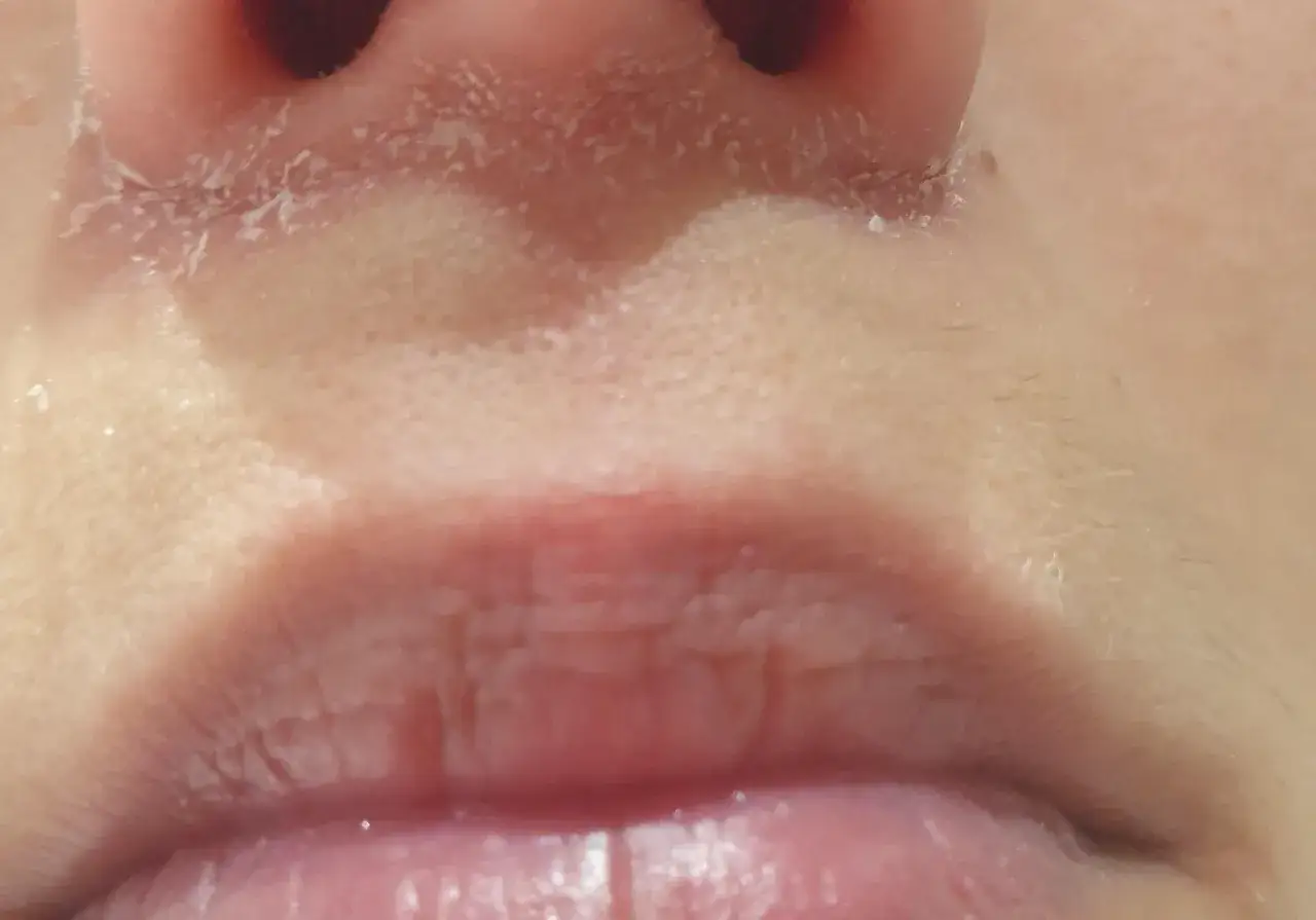 Pelle secca e screpolata intorno al naso, con segni di dermatite. Le labbra appaiono disidratate.
