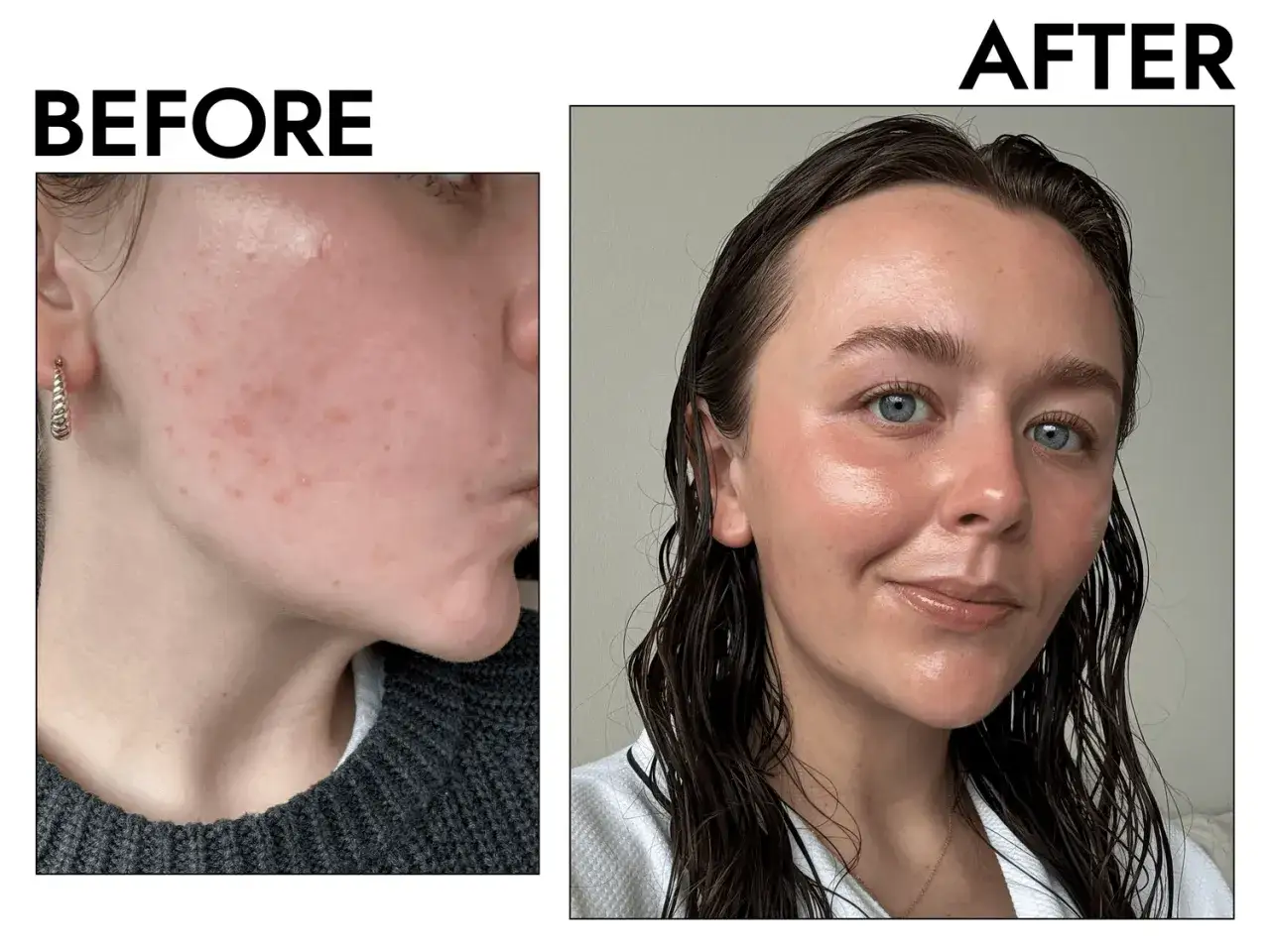 Före och efterbilder visar en hud med akne som behandlats med retinol. Huden är nu klarare och jämnare.
