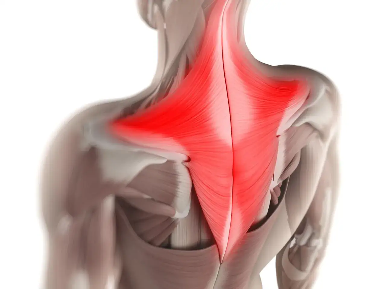 R&uuml;ckenansicht mit hervorgehobenem, schmerzhaftem trapezius muskel.