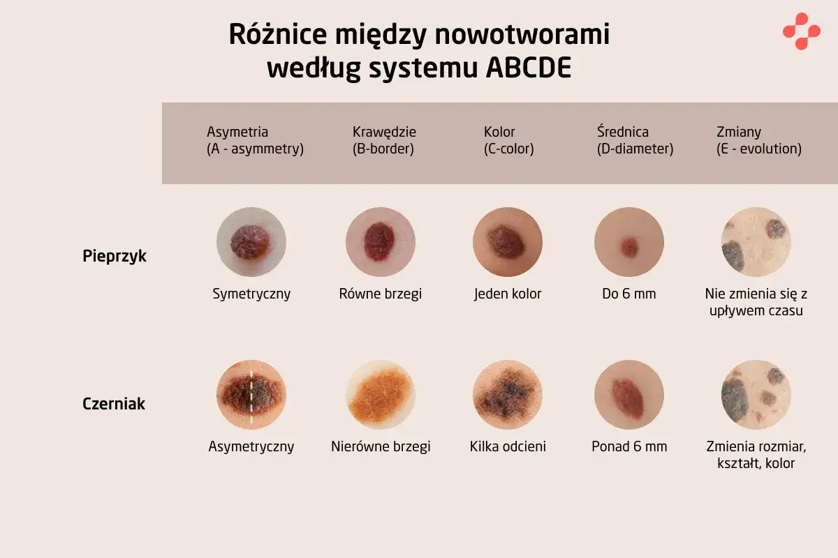 Porównanie pieprzyka i czerniaka wg ABCDE: asymetria, brzegi, kolor, średnica, zmiany. Pomaga rozpoznać raka skóry.