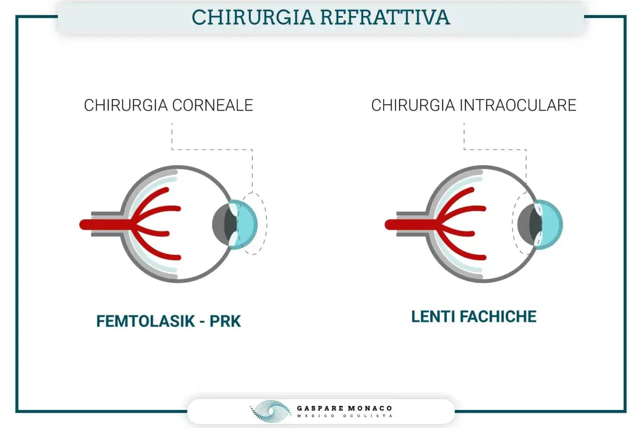 Chirurgia refrattiva: due approcci, chirurgia corneale (Femtolasik-PRK) e intraoculare (lenti fachiche), per correggere difetti visivi.