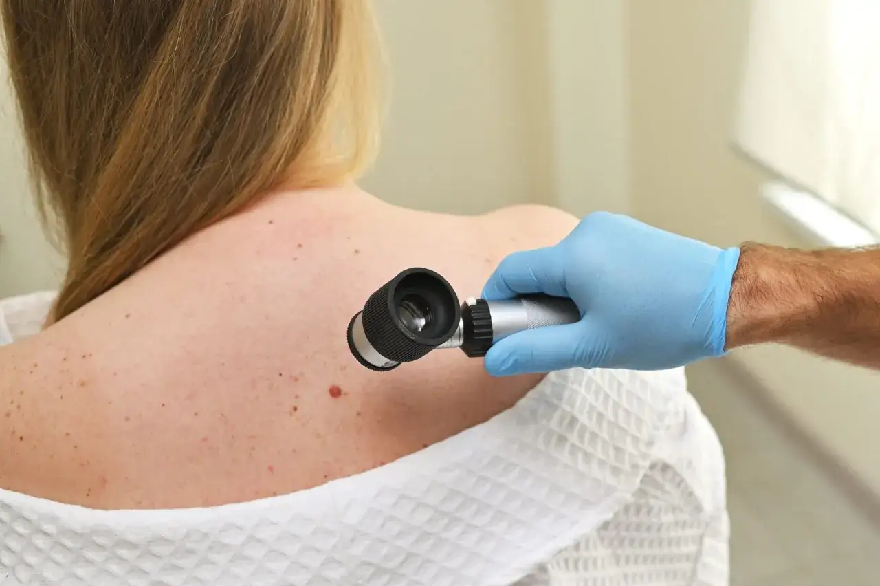 Lekarz w niebieskiej rękawiczce bada pieprzyki na plecach pacjentki dermatoskopem. To ważna wizyta u dermatologa.