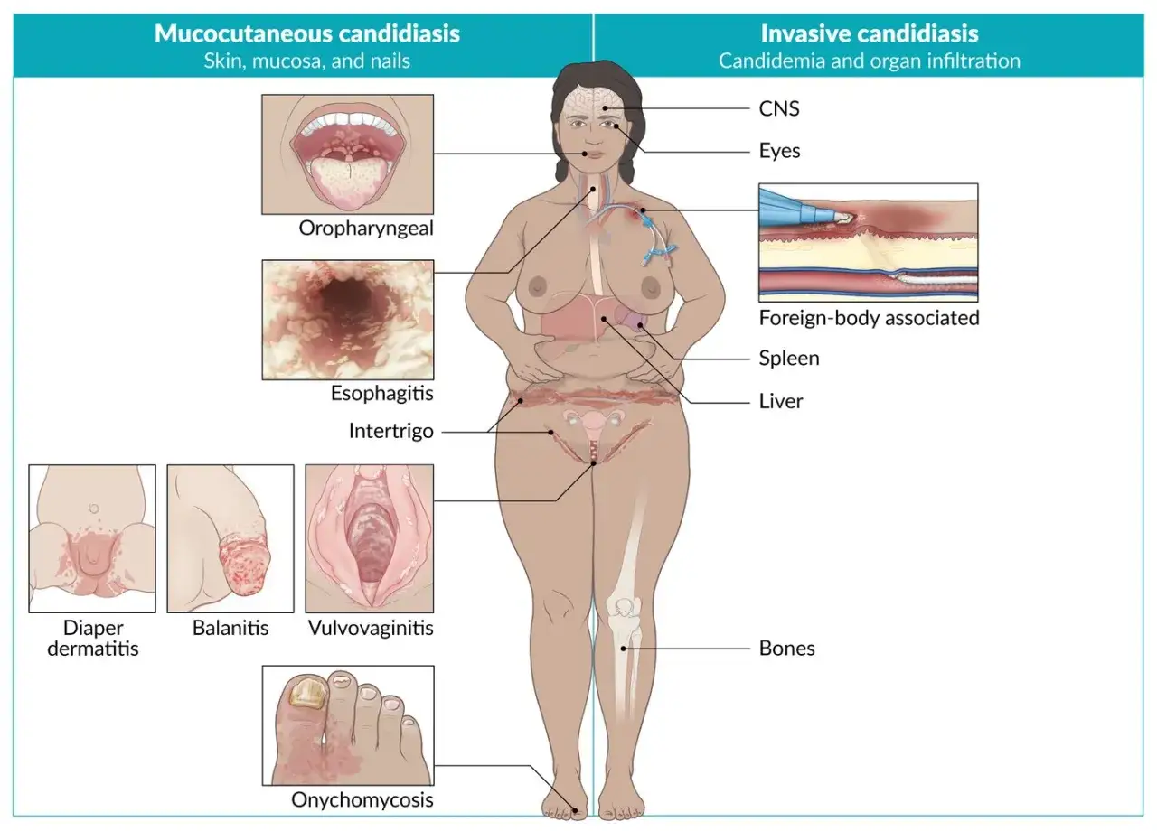 Illustration visar candidainfektion magen och andra kroppsdelar, inklusive hud, svalg, matstrupe, naglar och organ som lever och mjälte.