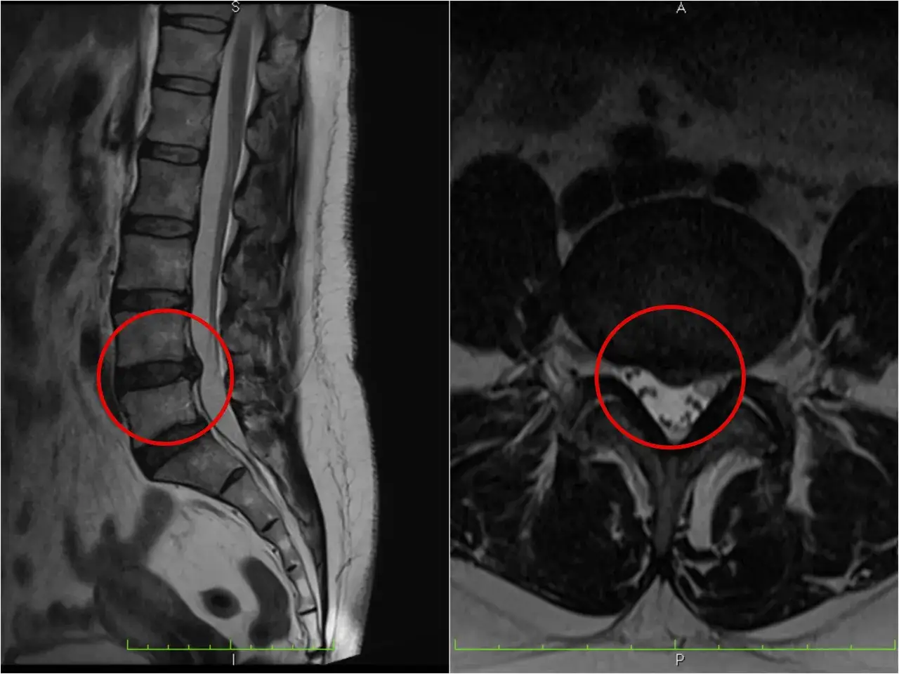 Rezonans magnetyczny kręgosłupa lędźwiowego uwidacznia przepuklinę krążka międzykręgowego, uciskającą na struktury nerwowe.