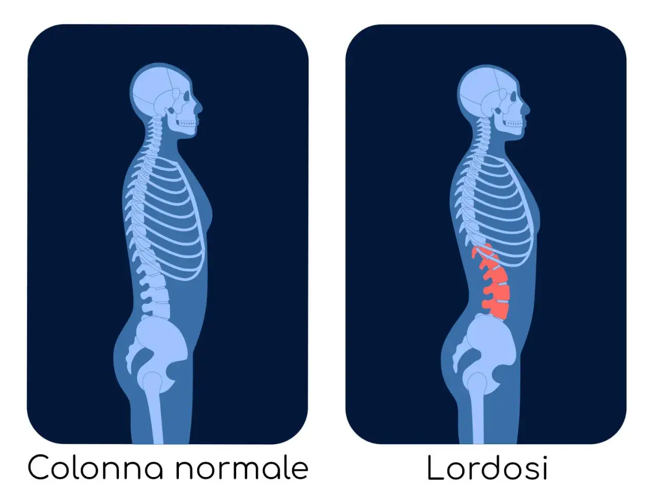 Confronto tra colonna vertebrale normale e ipercifosi lombare. La seconda immagine evidenzia una curvatura accentuata nella zona lombare.