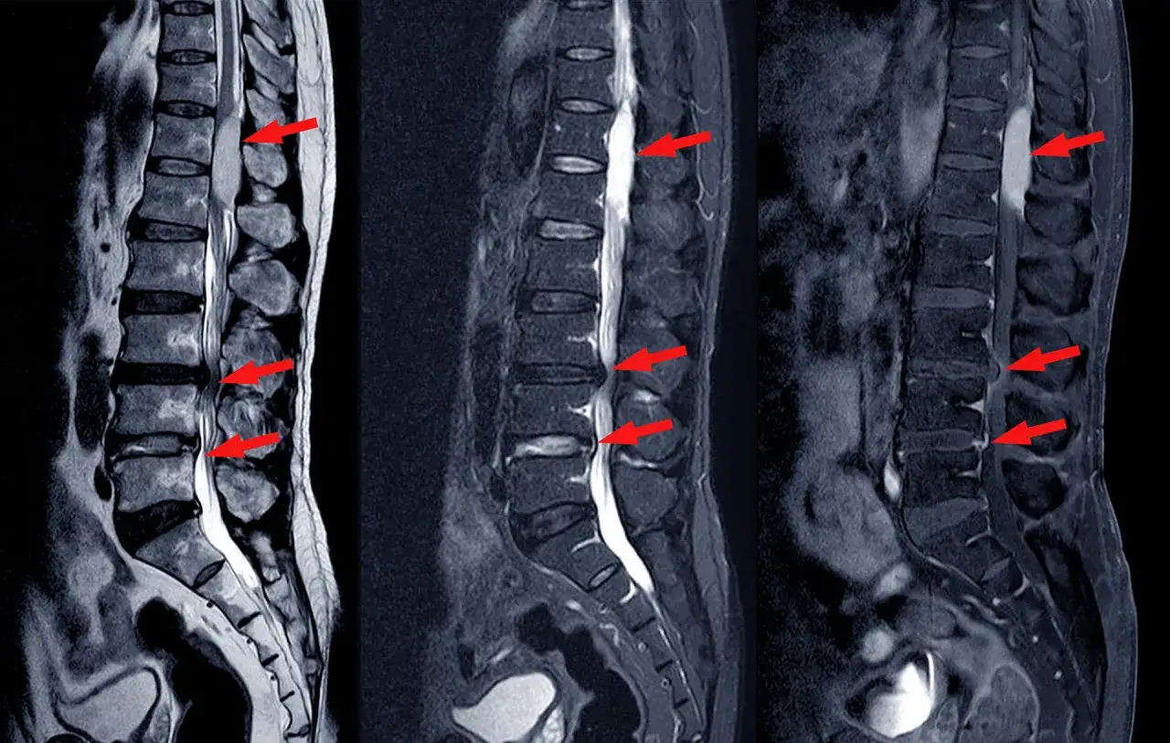 MRI kręgosłupa. Czerwone strzałki wskazują na zmiany, które mogą być objawem dyskopatii.