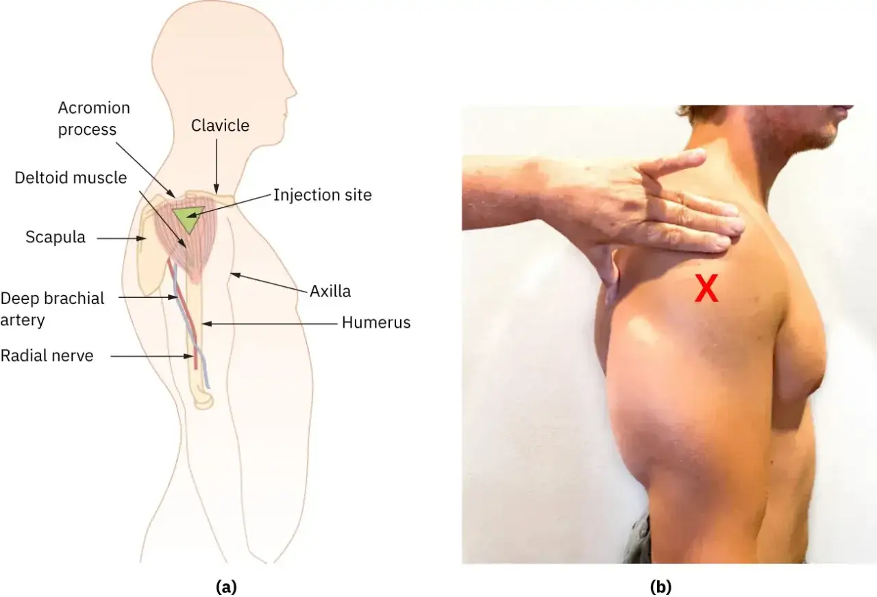 Anatomische Darstellung der Schulter mit Markierung für eine Muskel Spritze. Ein Mann zeigt die Injektionsstelle am Deltamuskel.