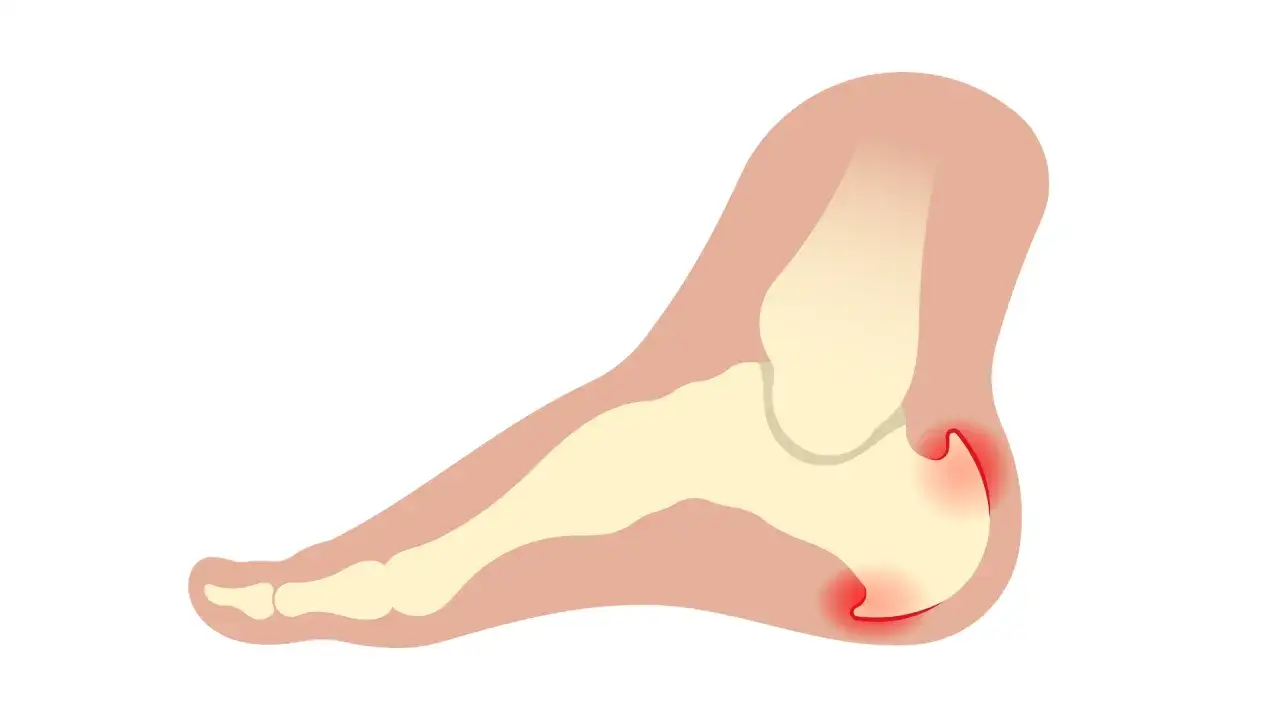 Illustration des Fußes mit roter Markierung an der Ferse, die auf fersensporn symptome hinweist.