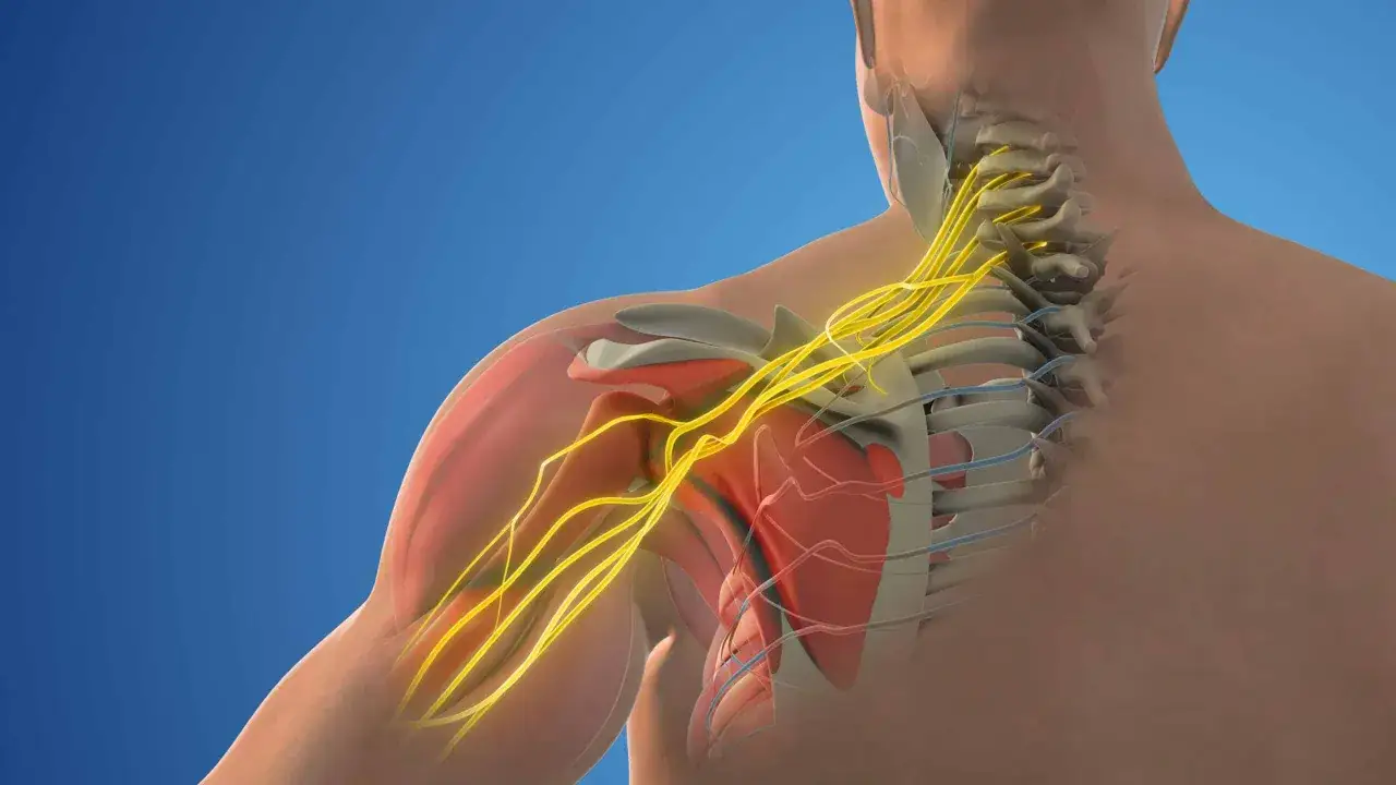 Ilustraci&oacute;n m&eacute;dica que muestra el plexo braquial y la columna cervical, destacando la posible causa de un pinzamiento de nervio trapecio.