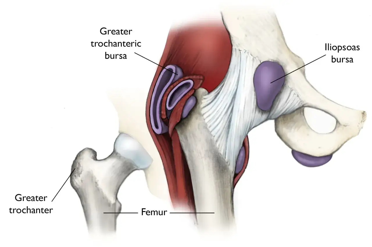 Ilustracja anatomiczna biodra z zaznaczonym zapaleniem kaletki krętarza większego. Widoczne kości miednicy i uda, mięśnie oraz kaletki.