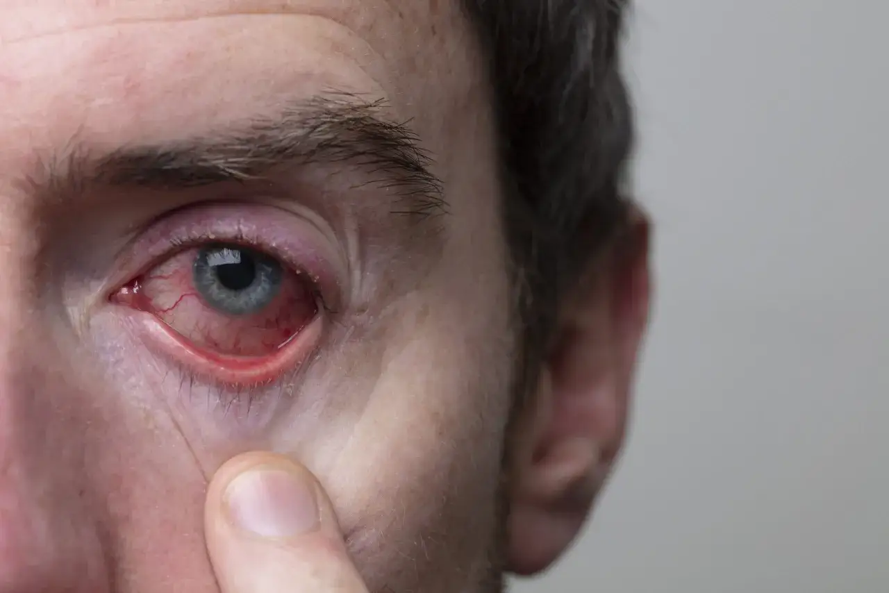 Occhio con forte arrossamento e gonfiore, segno di un contorno occhi irritato. La palpebra inferiore è visibilmente infiammata.