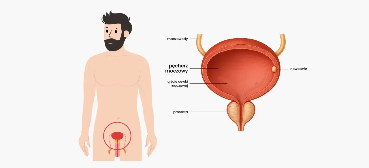 Anatomia męskiego układu moczowego z zaznaczonym pęcherzem moczowym, moczowodami, prostatą i nowotworem.