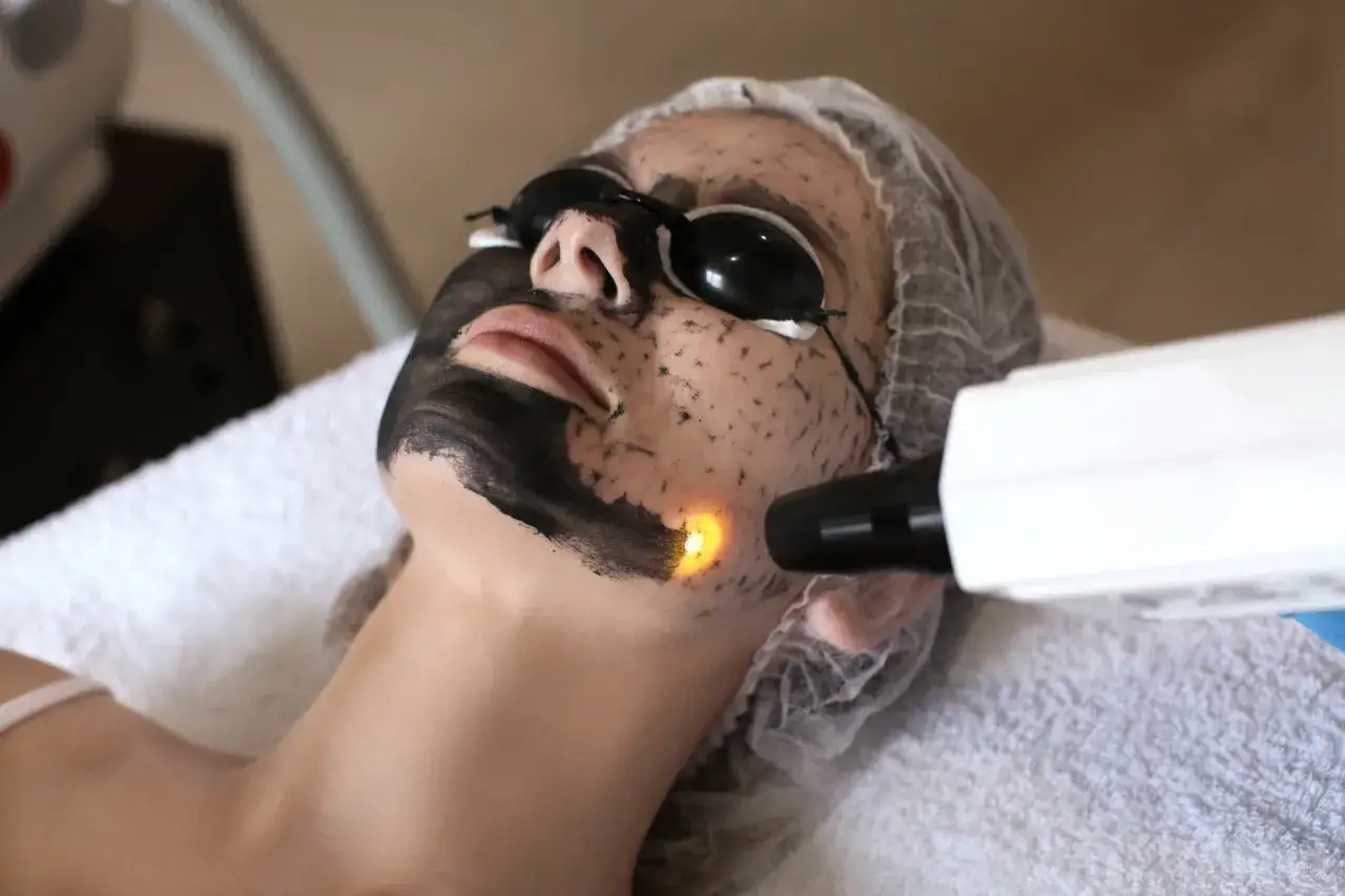 Kobieta w okularach ochronnych poddana zabiegowi peelingu węglowego. Laser rozświetla jej twarz pokrytą czarną maską.