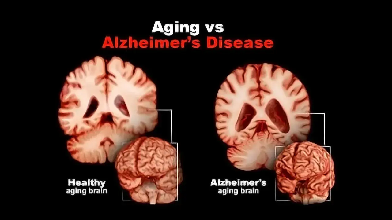 Porównanie mózgu zdrowego starzejącego się z mózgiem dotkniętym chorobą Alzheimera. Widoczne zaniki tkanki mózgowej, jeden z objawów alzheimera.