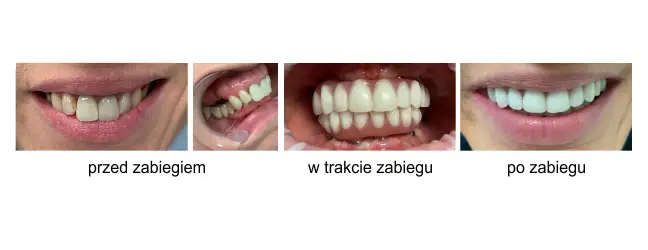 implanty zębowe przed i po